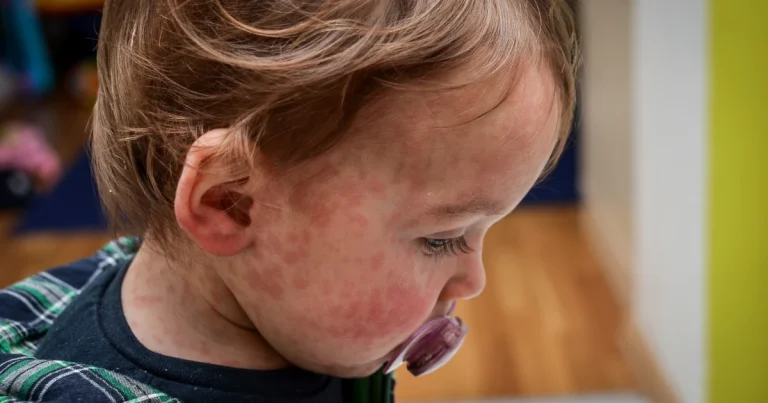 Qué hacer si el bebé presenta alergia a algún alimento